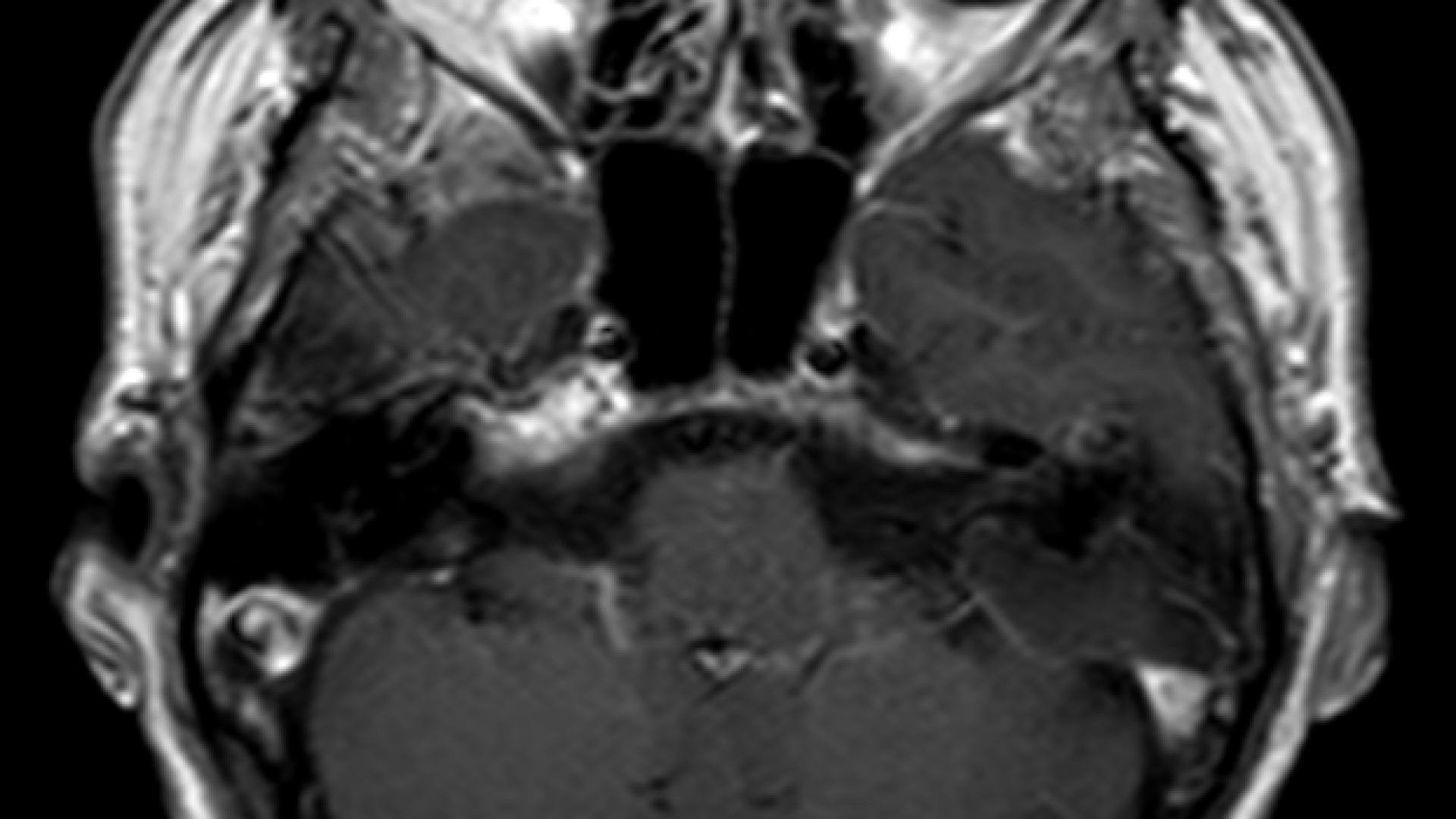 Colesteatoma della rocca petrosa t1mdc