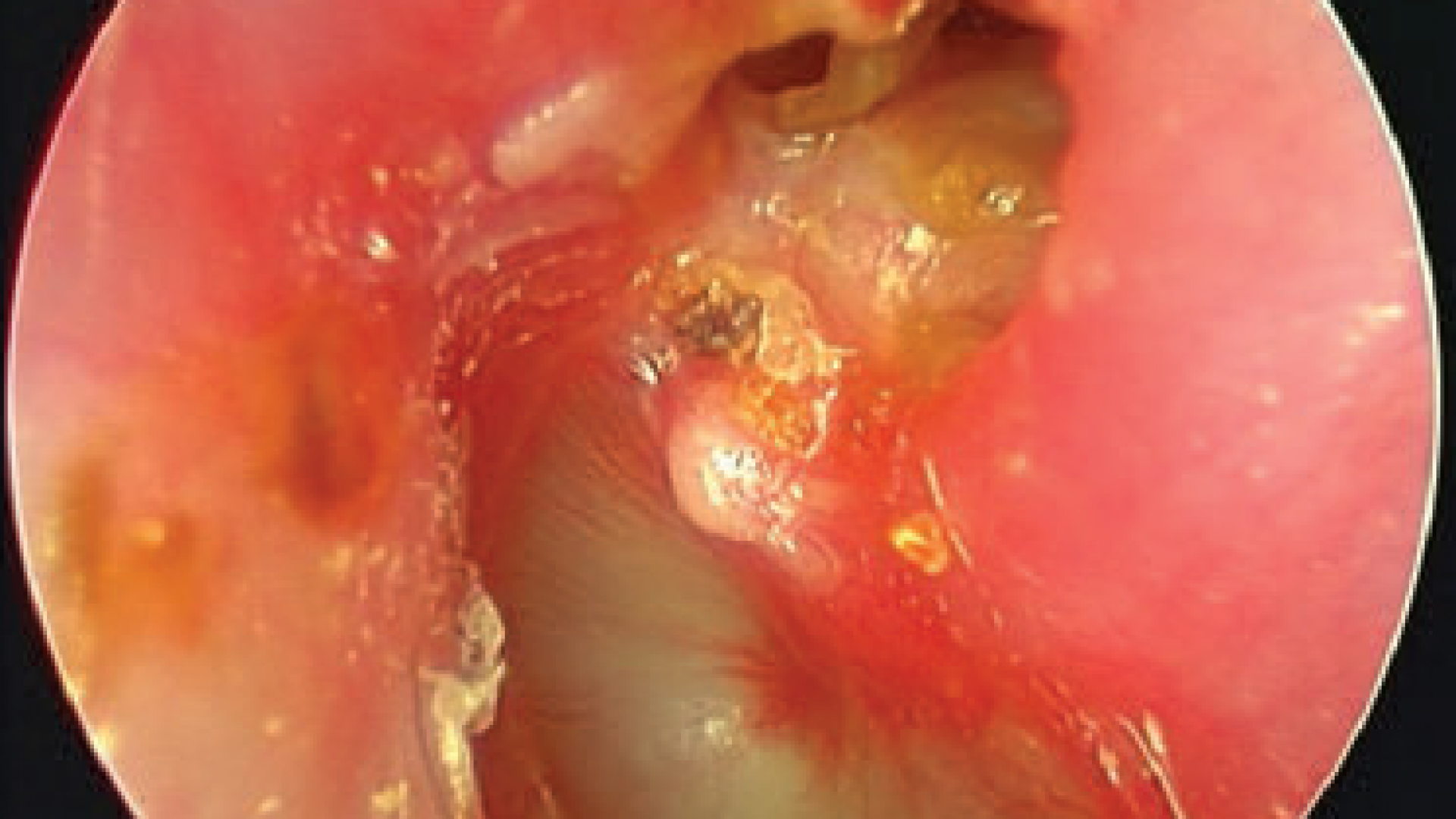 Colesteatoma